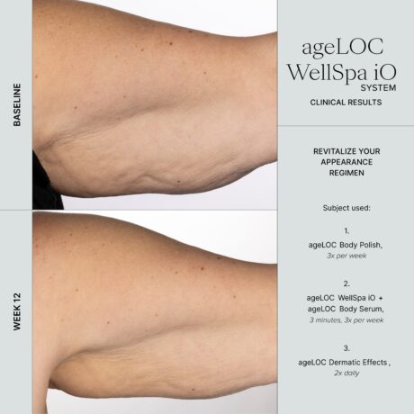 WellSpa iO before after 3min 3x arm (1)